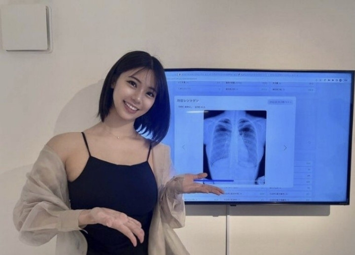 H사이즈 가슴 성형 의혹에 엑스레이 공개한 모델